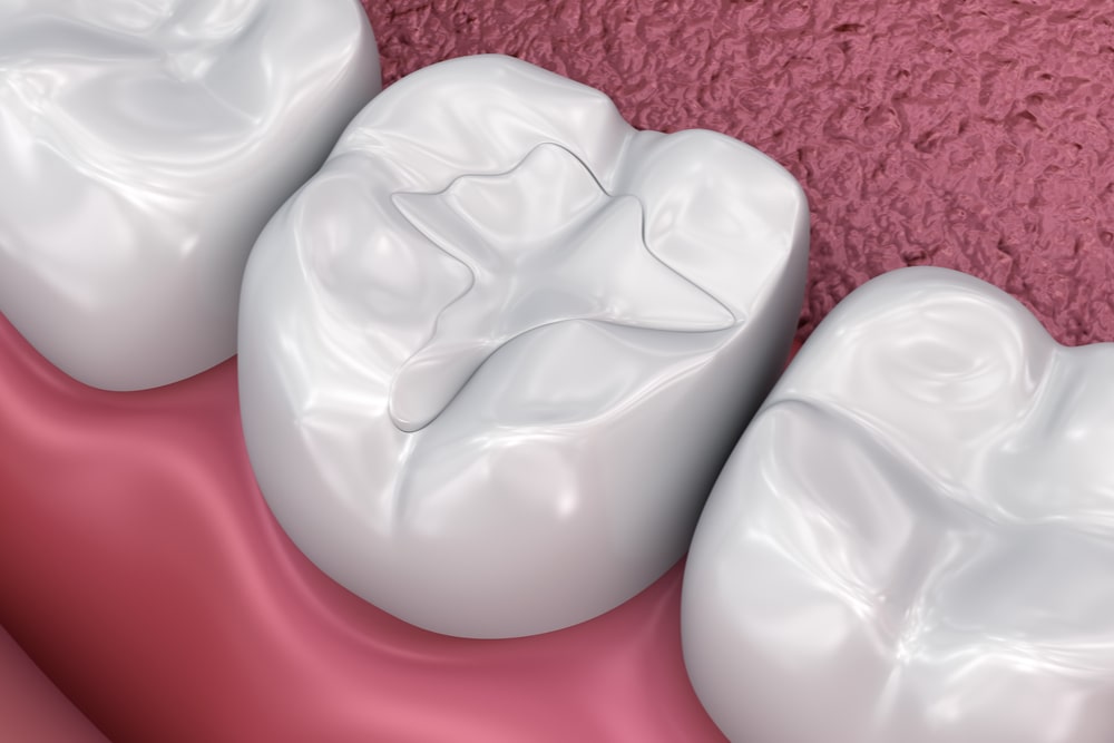Dental fissure fillings